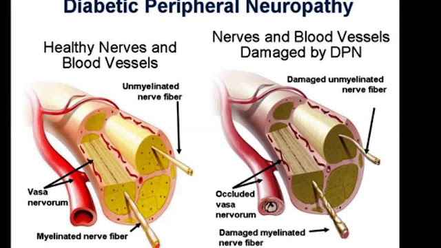 What Is Nerve Gliding and Can It Help With Diabetic Neuropathy in the Feet
