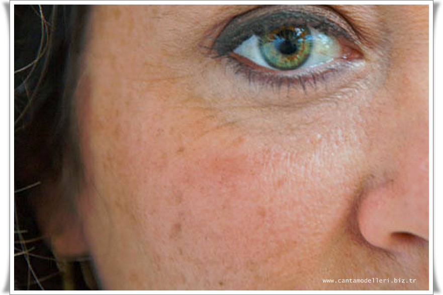 коричневые пятна под глазами. пигментация кожи под глазами. гиперпигментация хлоазма. пигментные пятна под глазами. веснушки, лентиго, мелазма.