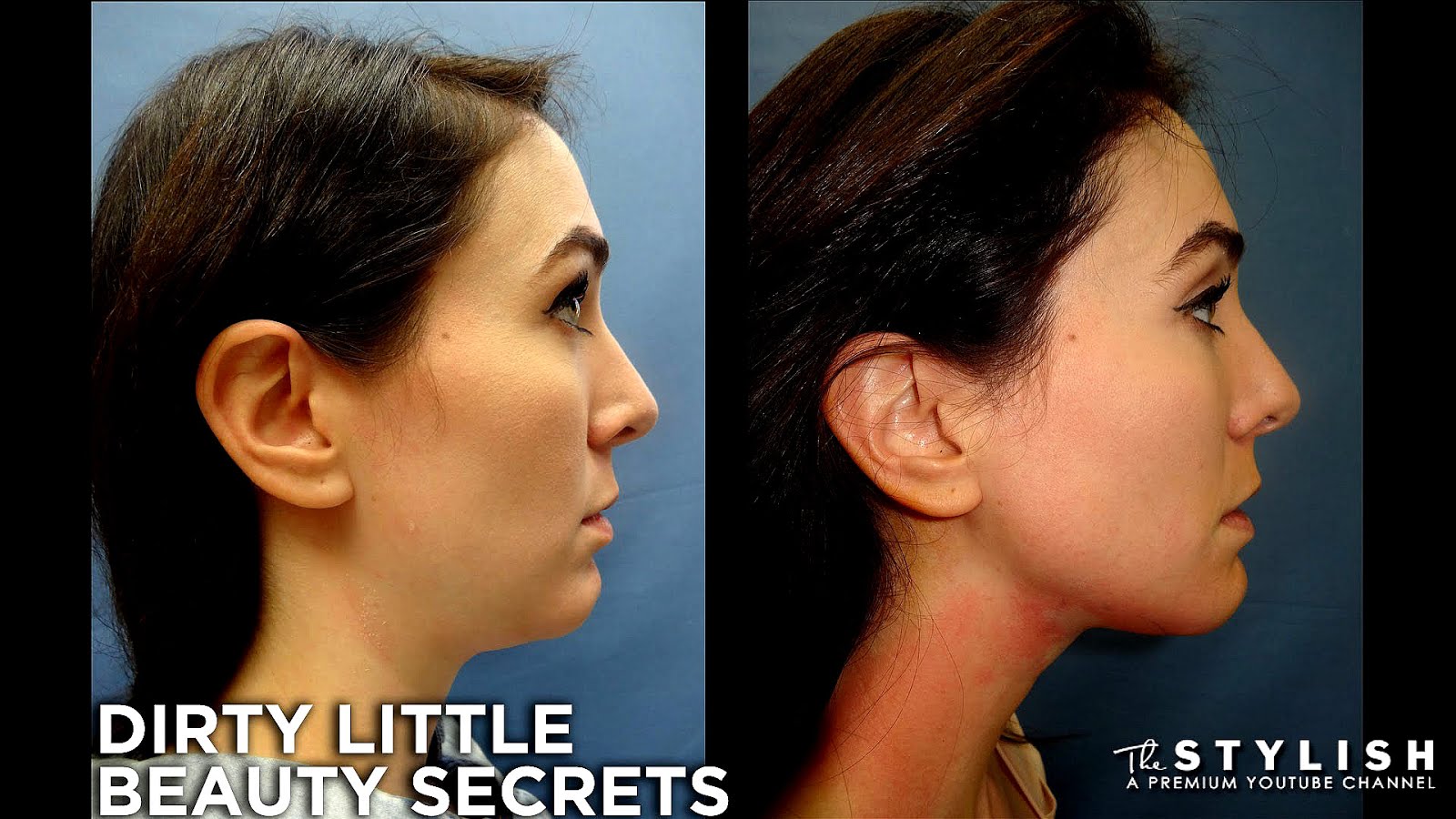 Rhytidectomy Mini Neck Lift Lift Choices