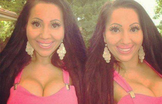 Worlds most identical twins before surgery