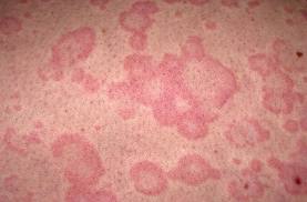 Allergic contact dermatitis due to an allergy from formaldehyde exposure