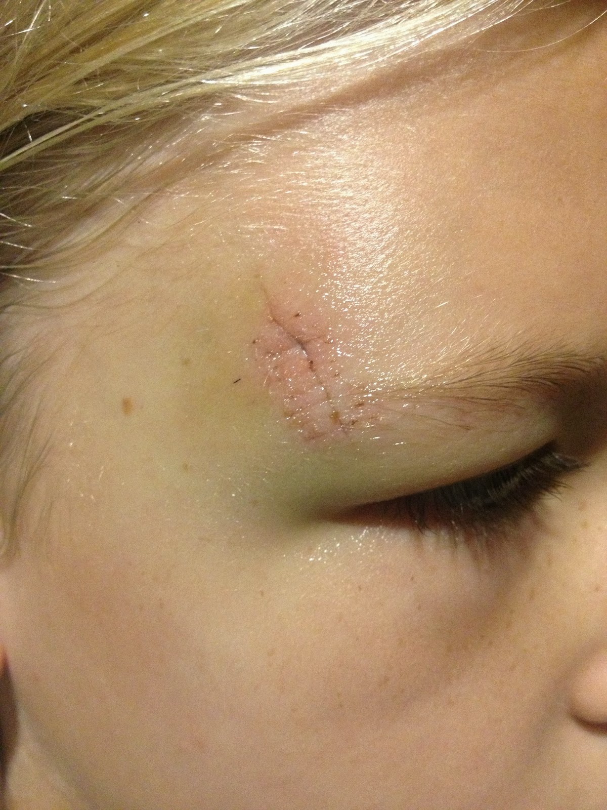 GOT MOXY? Bunk Bed Injuries