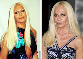 Kegagalan Operasi Plastik Donatella Versace
