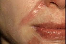 Cara Menghilangkan Keloid Di Wajah Cara Menghilangkan Keloid Di Wajah