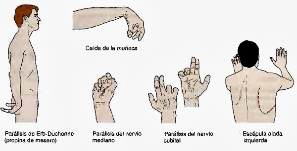 Lesion del nervio mediano cubital y radial