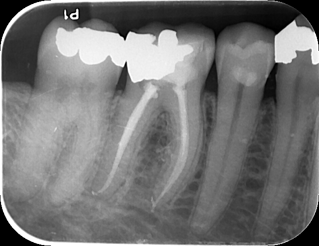 root canal x ray root canal xray