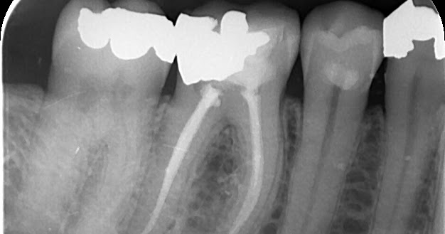 root canal x ray root canal xray
