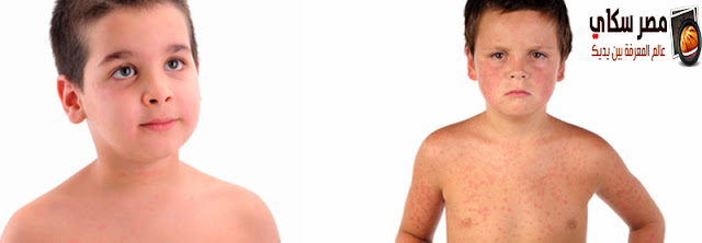 كيفية التمييز بين مختلف أنواع الطفح الجلدى Skin rash كيفية التمييز بين مختلف أنواع الطفح الجلدى Skin rash