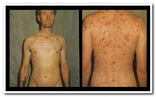 Obat Sipilis: Cara Mengobati Sipilis Obat Sipilis: Cara Mengobati Sipilis