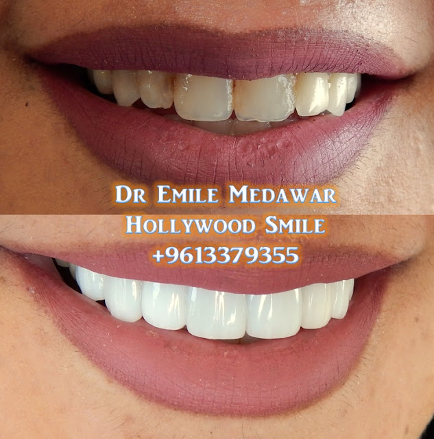 Beautiful Lebanese Smile, Dr Emile Medawar, 00 961 3 379355 The Best