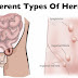 HERNIA thumbnail