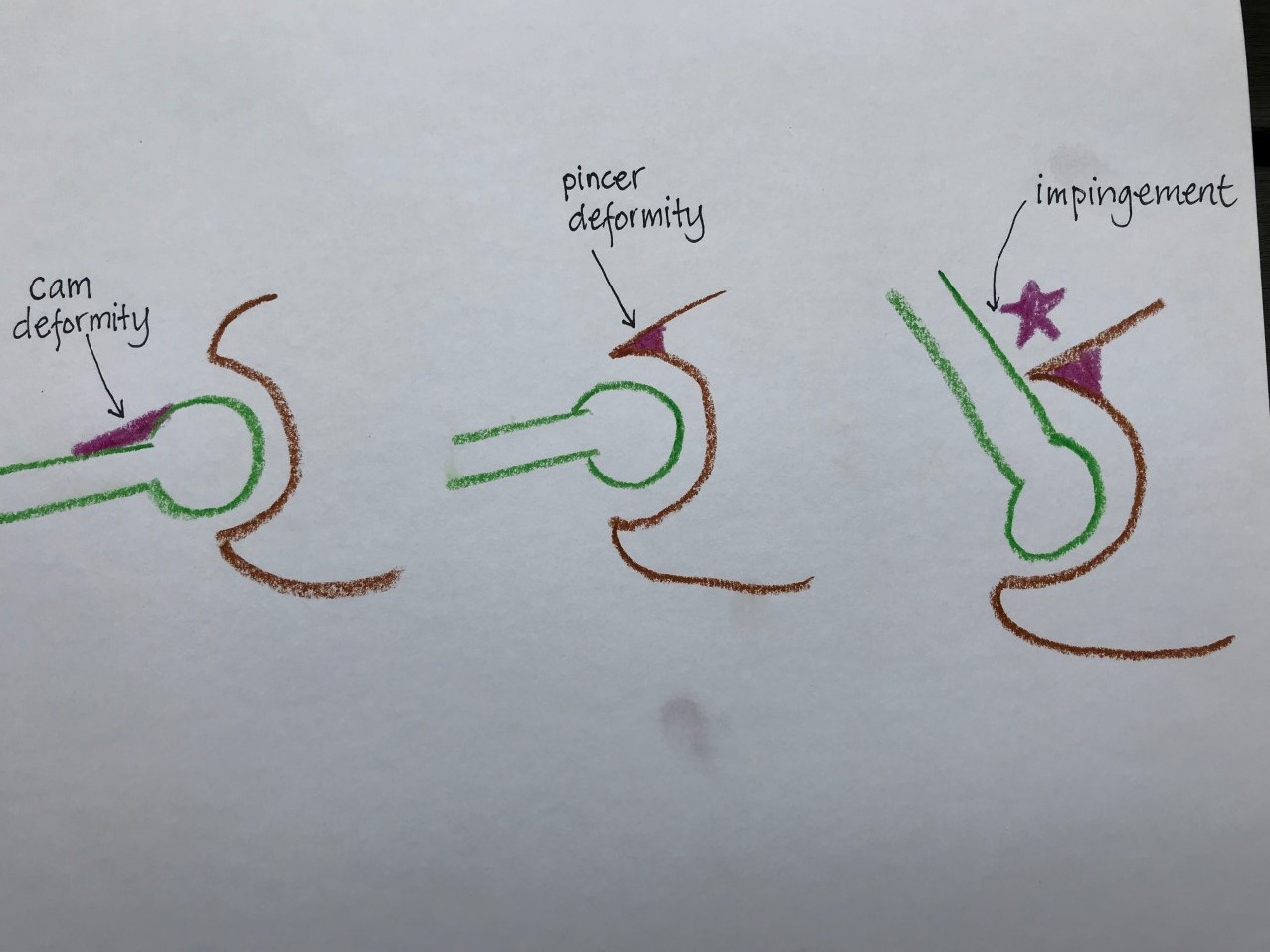 Running Solutions Diagnosed With Hip Impingement But Still Completed