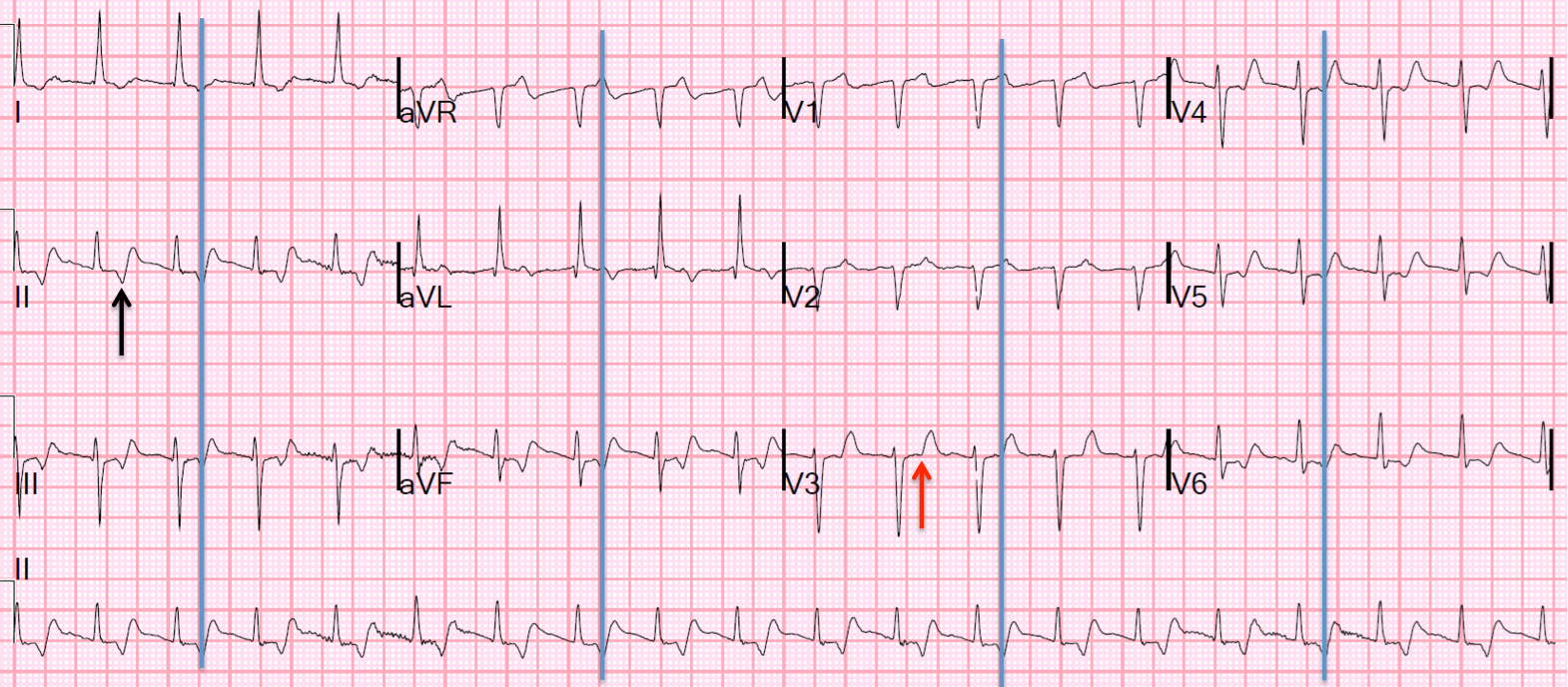 Can P Waves Travel Through All Mediums Can P Waves Travel Through All Mediums