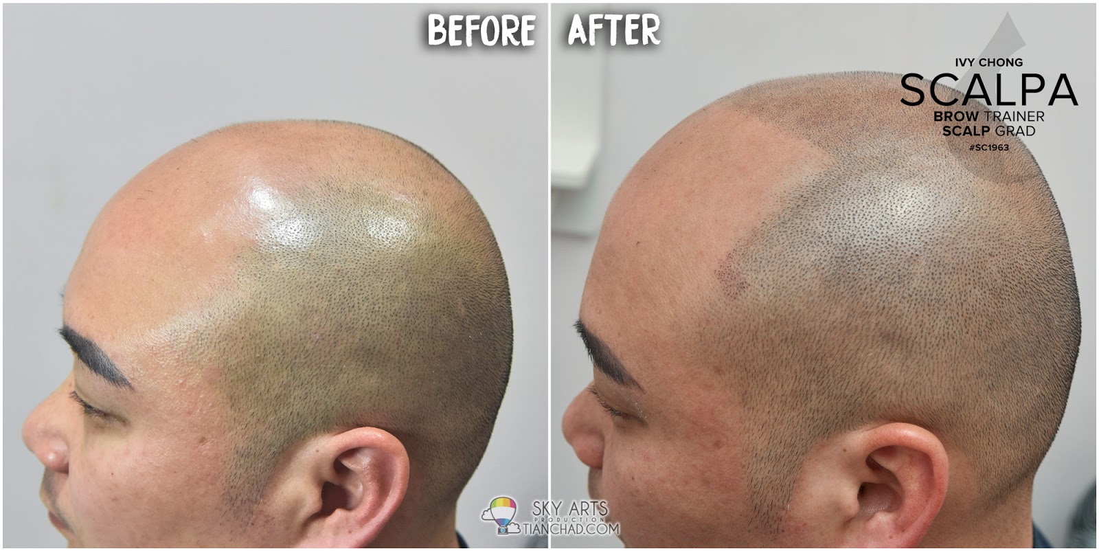 Best Scalp Micropigmentation (SMP) in Malaysia SMP 让你不再为秃头而烦恼