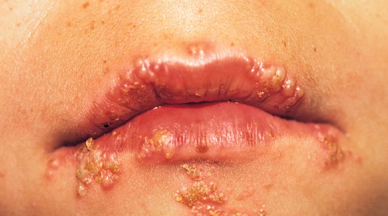 https://4.bp.blogspot.com/-iqWOI-hqKkc/WO92XAKdegI/AAAAAAAAAco/WAggVZxfbKcn_zL2BAUCvgT7XzbXowbNgCEw/s1600/herpes%2Bdos.jpg