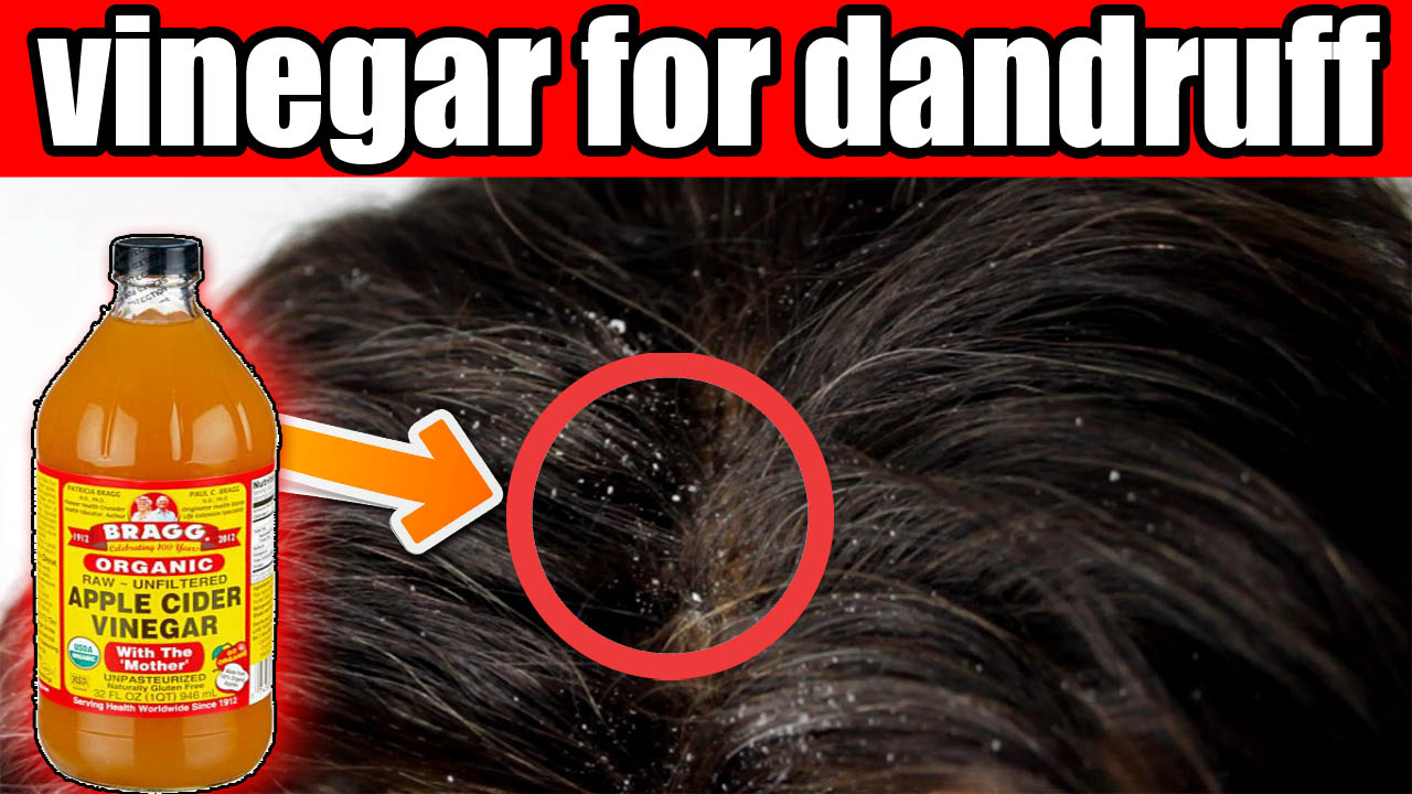 Best Ways To Use Apple Cider Vinegar For Dandruff Treatment