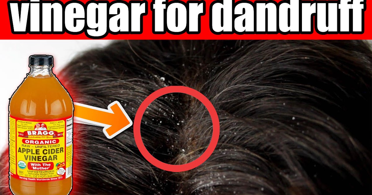 Best Ways To Use Apple Cider Vinegar For Dandruff Treatment Natural