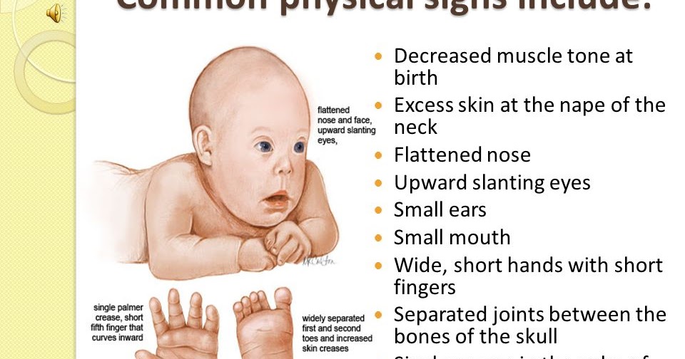 dua-kali-down-syndrome-anugerah-tuhan-down-syndrome-trisomy-21