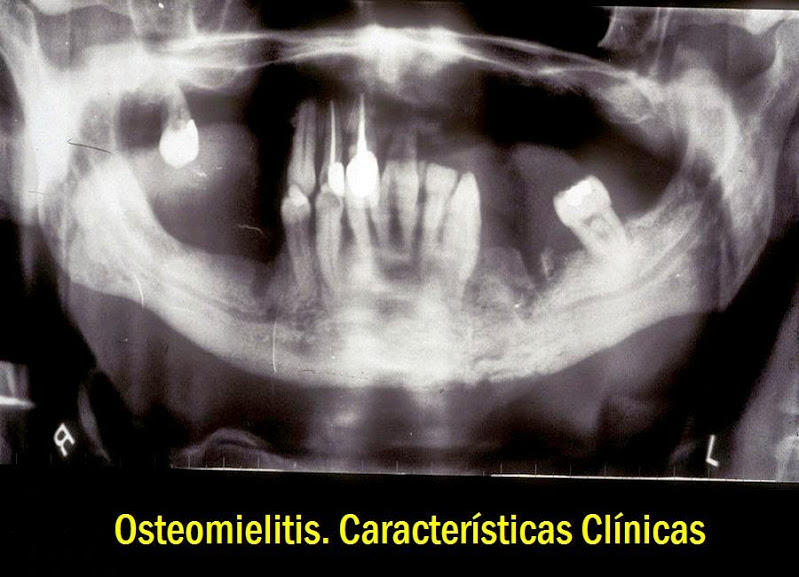 OSTEOMIELITIS Características Clínicas