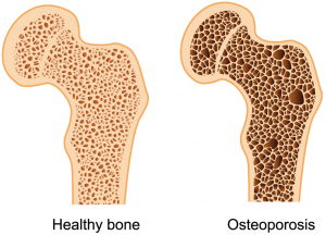 image showing Difference between Normal and Porotic bone