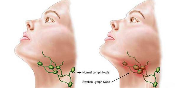 Beware of signs symptoms of cancer of the lymph nodes swollen before too late Beware of signs symptoms of cancer of the lymph nodes swollen before too late
