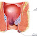 obat ambeien wasir luar oles thumbnail