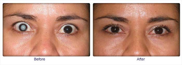 Before and After Cataract Surgery Before and After Cataract Surgery