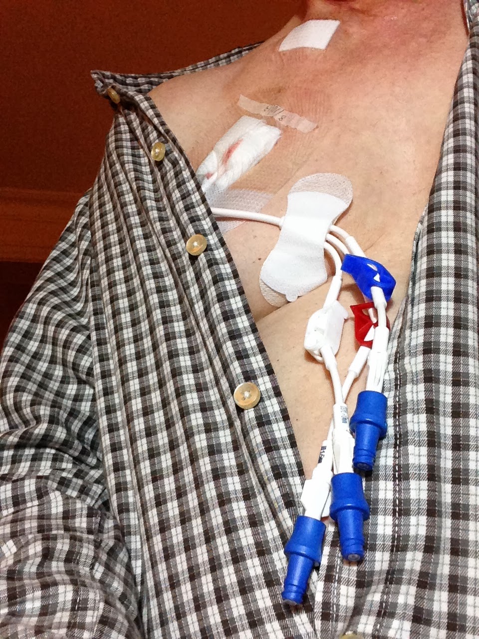 MDS in the family Hickman Line Day