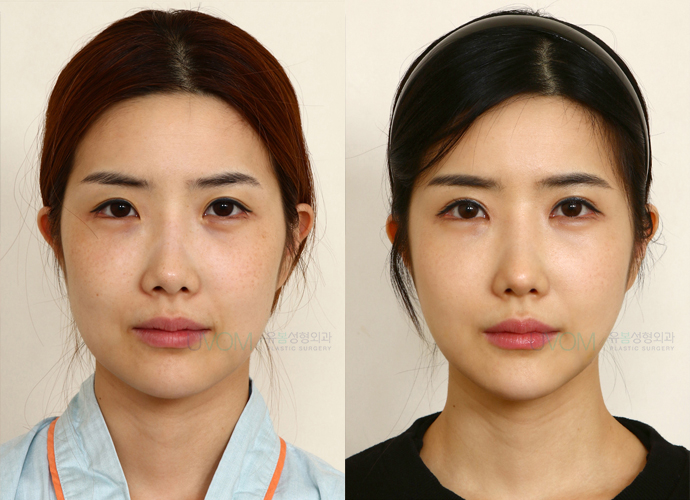 UVOM Plastic Surgery Face Contouring Before and After