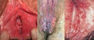 daging tumbuh di bibir dalam vagina