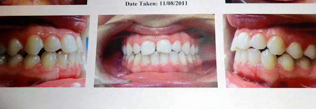 braces albuquerque before photo