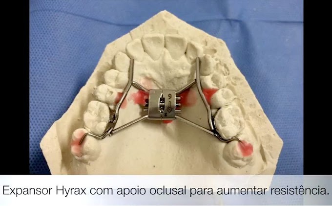 ORTODONTIA: Aparelho Herbst passo a passo: do clínico ao laboratorial