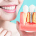 What Is Bone Graft? What Are The Risk Factors Involved?