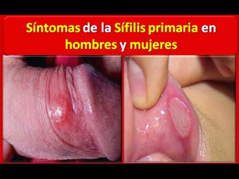 simptome de sifilis pe penis)