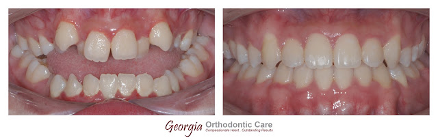 under bite, class III, openbite, cross bite, Orthodontics, orthodontists, orthodontists near me, orthodontics near me,  ortodoncista, Ortodoncia, Especialista, Dentista ,Clear, Invisible, Braces, Invisalign, underbite, class III, face mask, non-surgery, non-extraction, crossbite, overbite, class II, crooked, spaced, crowding, teeth, severe, jaw alignment, cosmetics, implants, children, dentists, dentistry, friendly, adults, children, family, Lawrenceville, Norcross, Buford, Hamilton Mill, Dacula, Auburn, Sugar Hill, Sugar Loaf, Doraville, Chamblee, Stone Mountain, Decatur, Collins Hill, Snellville, Suwanee, Grayson, Lilburn, Duluth, Cumming, Alpharetta, Marietta, Dekalb, Gwinnett, County, Atlanta, North Georgia, GA, Georgia, 30043, 30093, affordable, Vietnamese, Spanish, speaking, weekend, Saturday, appointments, Dr. Quang Nguyen, Georgia Orthodontic Care, Nguyen Orthodontics.