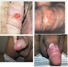 penyakit raja singa pada penis penyakit raja singa pada penis