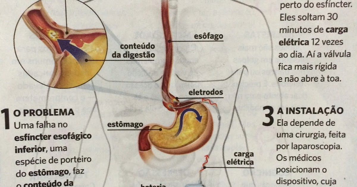 Marcapasso para o tratamento do Refluxo