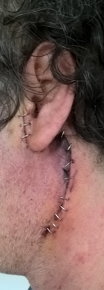 Under the knife adenoma pleomorfo