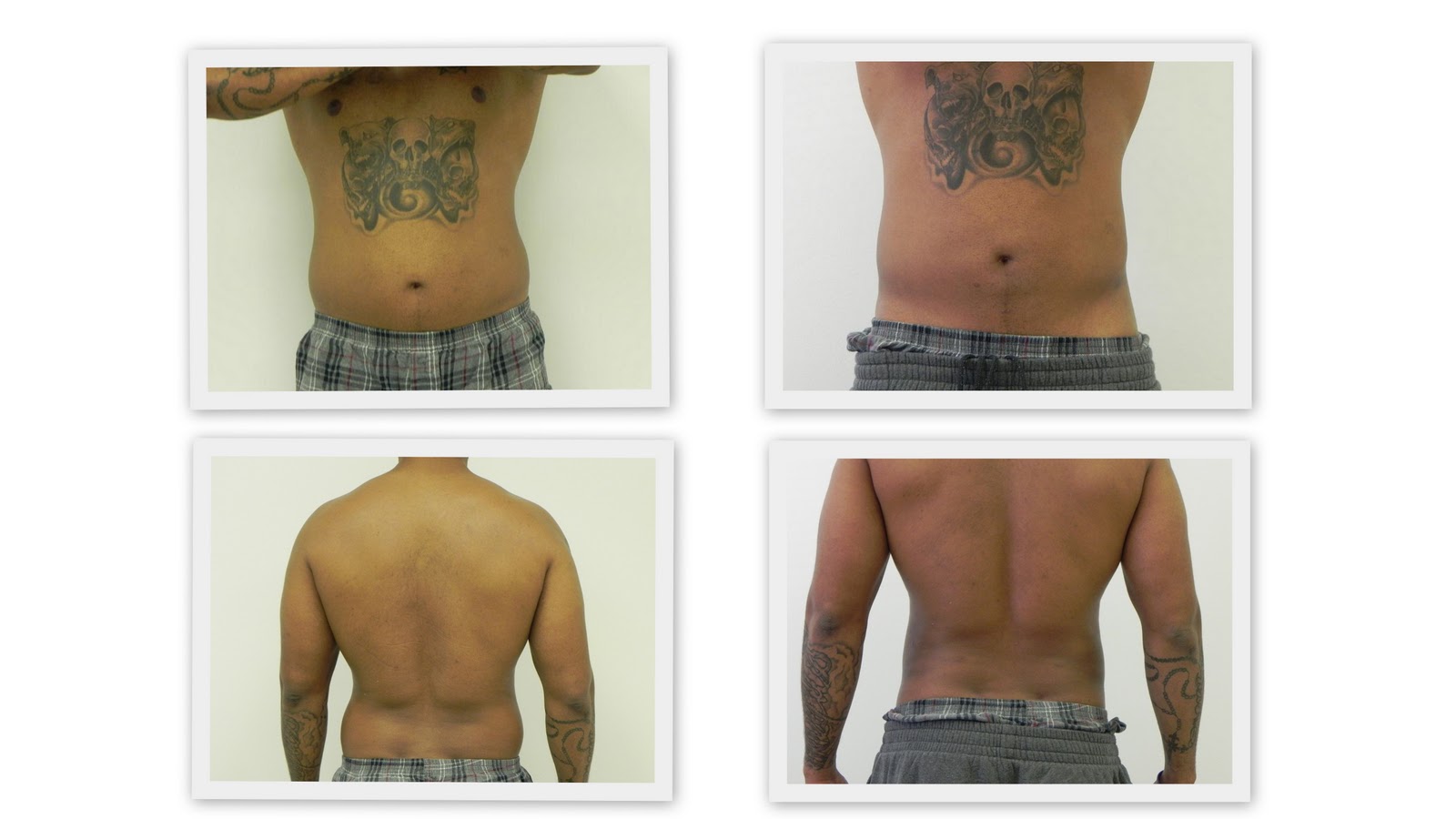 My Laser Lipo Journey American Lipo Centers More Success Photos From