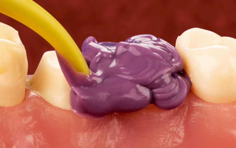 News Room ROE Dental Laboratory Best Bite Registration Materials