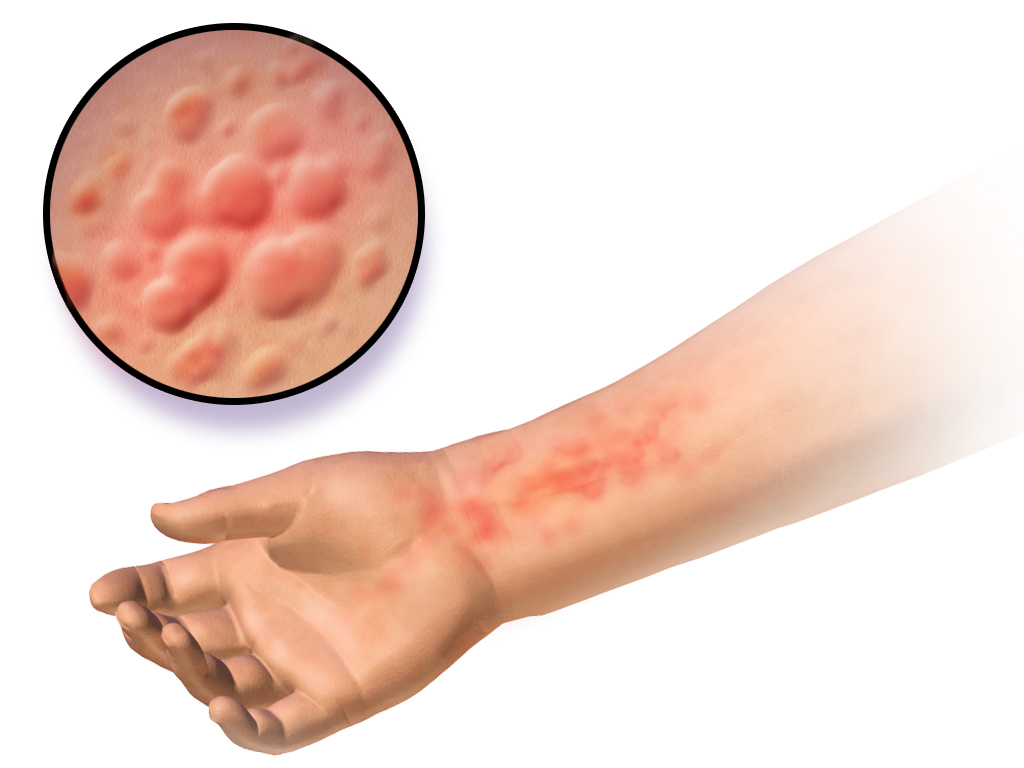 Skin Disorders and Infections. HEALTH INFORMATION
