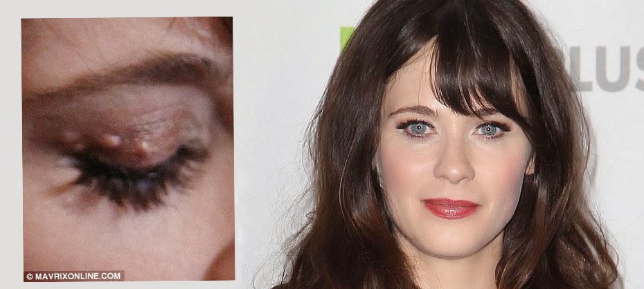 Get Rid Of Syringomas Naturally Get Rid Of Syringomas Naturally