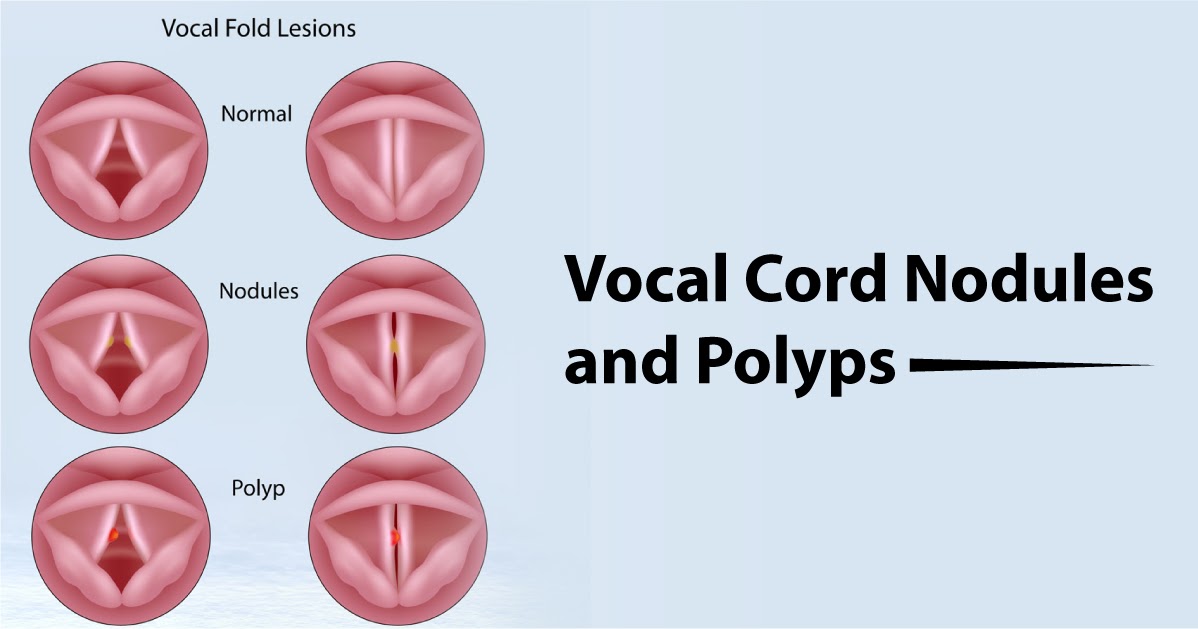 Vocal Cord Cysts and Polyps ~ Vikram ENT Hospital & Research Institute