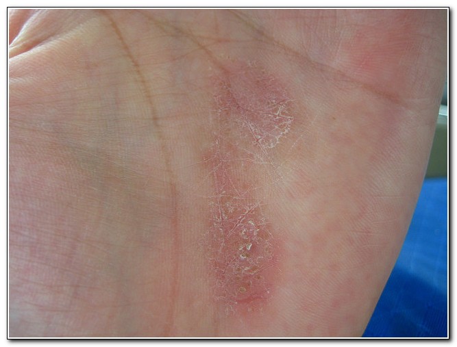 Some Pictures Of Laundry Detergent Rashes ALL AROUND LAUNDRY