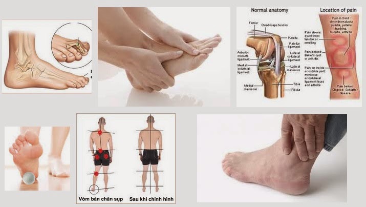 Các triệu chứng đau bàn chân gây đau chân