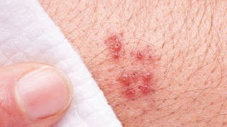 Como Curar Los Herpes Como Curar Los Herpes