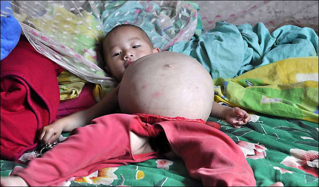 5 Bayi Aneh Bin Ajaib Yang Lahir di Dunia 5 Bayi Aneh Bin Ajaib Yang Lahir di Dunia