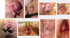 Foto OBAT APOTEK BAB BERDARAH HERBAL MANJUR