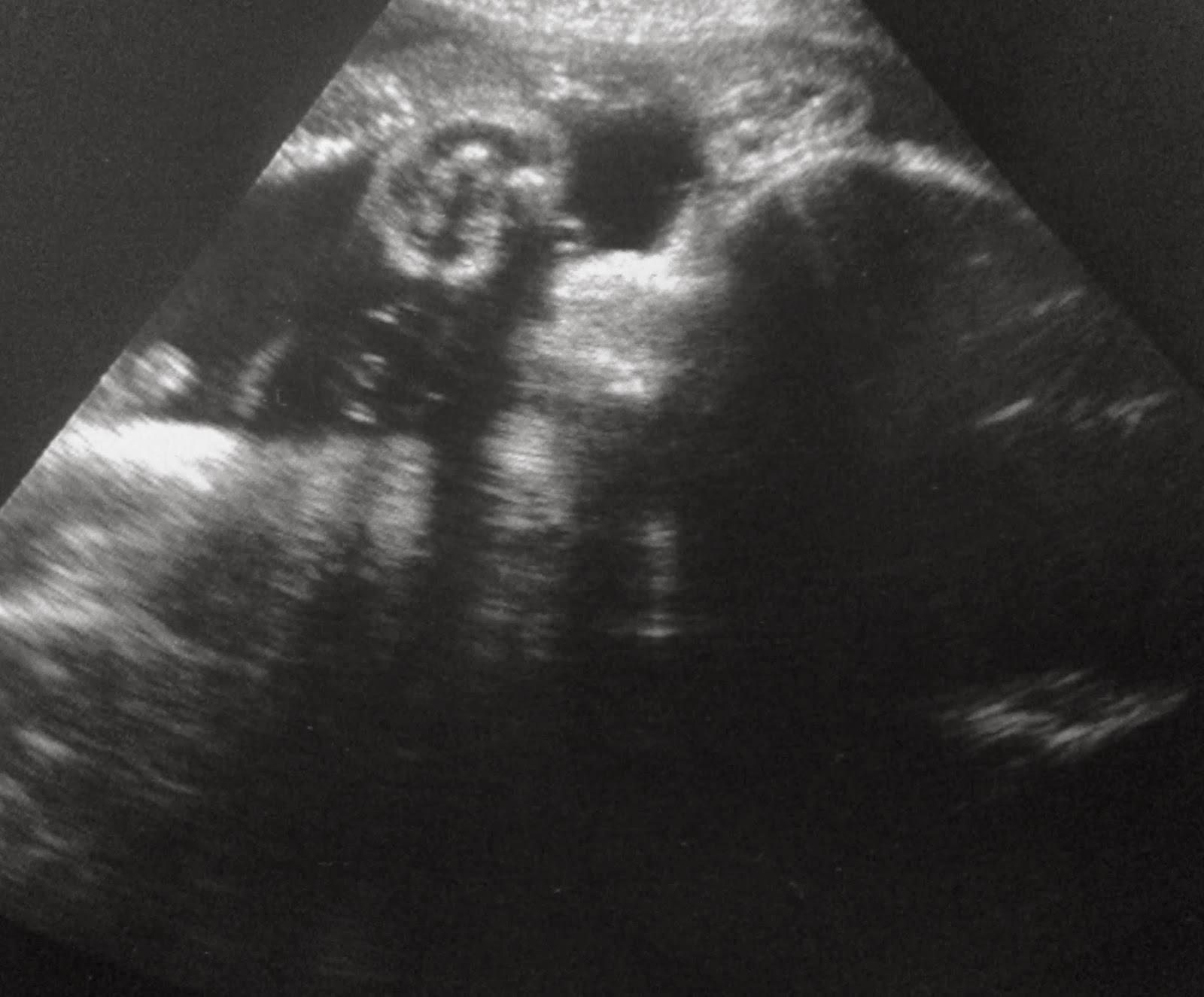 baby has big belly on ultrasound Luna ultrasound