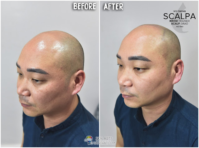Before and After 1st Scalp Micropigmentation (SMP) treatment 